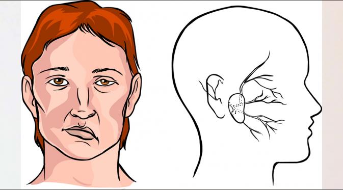 5 Cara Cegah Stroke di Usia Muda,