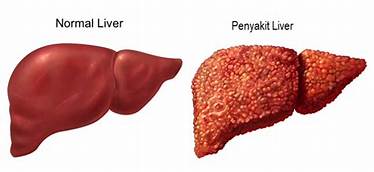 7 Penyebab Penyakit Liver