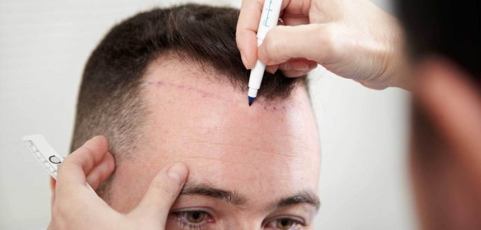 Transplantasi Rambut atau Tanam Rambut, Menurut Pandangan Islam