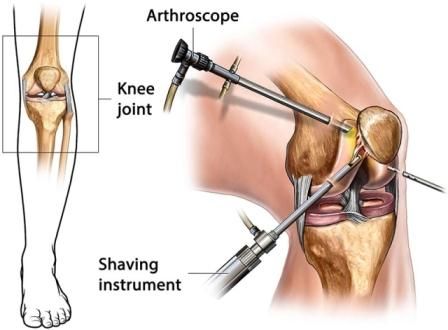 Fungsi Tulang Tempurung Lutut