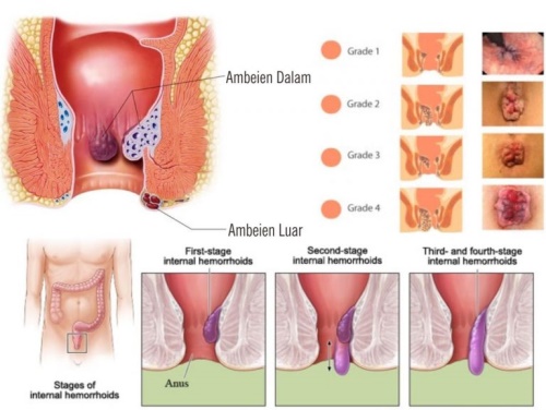 Kenali Jenis-Jenis Ambeien dan Cara Mengobatinya