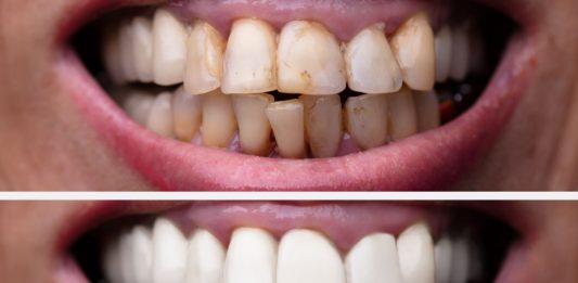 6 Tips Memutihkan Gigi dengan Bahan Alami