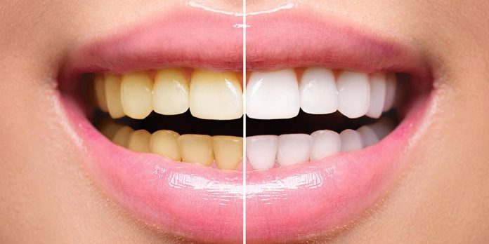 Cara Mudah dan Cepat Memutihkan Gigi yang Kuning