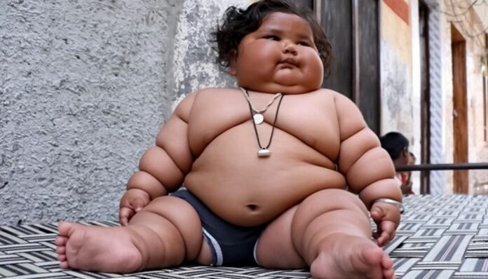 Obesitas pada Anak